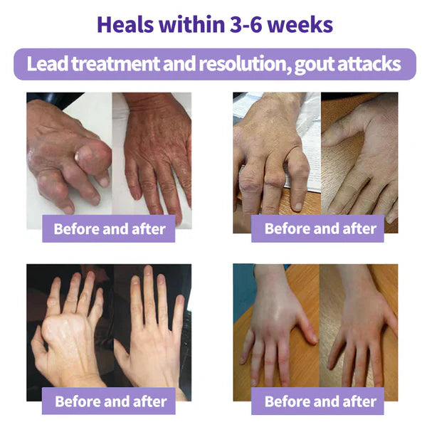 ✅ Official store: LOVILDS™ Turmeric & Emu Oil Arthritis Soothing Pain Relief Massage Gel(👨‍⚕️AAD Recommended)